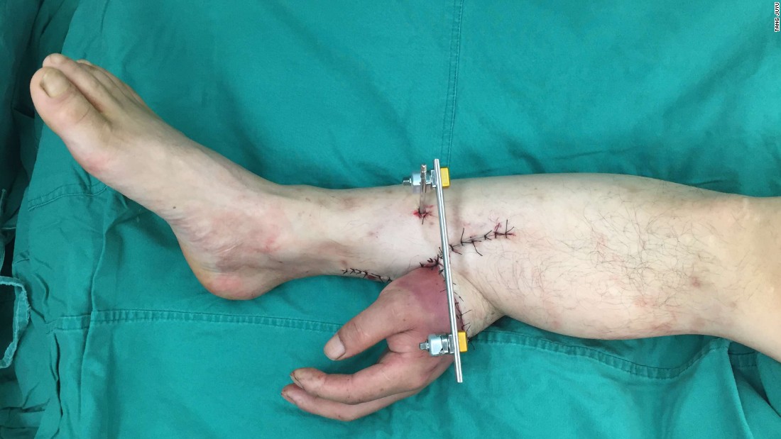 Saving A Severed Hand By Grafting To A Leg Cnn 