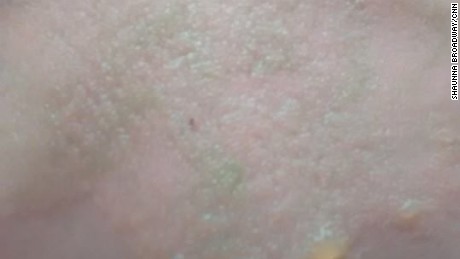 Mom: Boys suffer second degree sunburns at day care - CNN