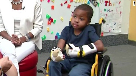 first bilateral child hand transplant kyw dnt_00000115
