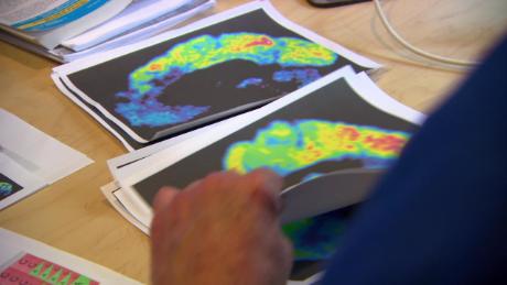 Nearly half of women and a third of men will develop dementia, stroke or Parkinson&#39;s, study says