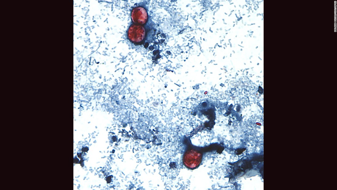 &lt;strong&gt;Cyclosporiasis:&lt;/strong&gt; An intestinal infection caused by the cyclospora cayetanensis parasite, seen here on a stool sample through a microscope on a slide. Cyclospora infect the small intestine and most commonly cause watery diarrhea; other symptoms include abdominal cramping, nausea and weight loss. 