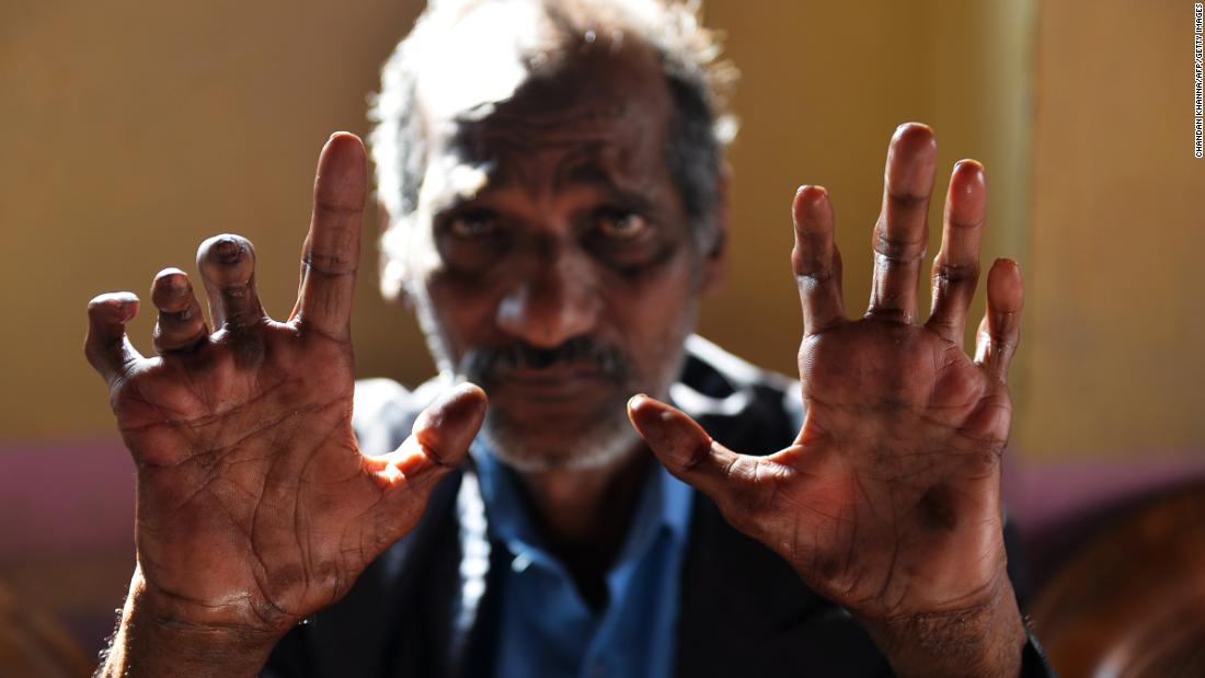 There were 216,000 global cases of leprosy, an ancient and disfiguring disease, in 2013. 