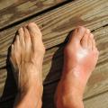 Foot with gout swollen