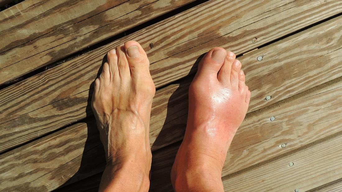 Gout was once known as the &quot;disease of kings&quot; because of its links to excessive food and alcohol consumption. These days, unhealthy lifestyles are behind an increase in gout in developed countries.