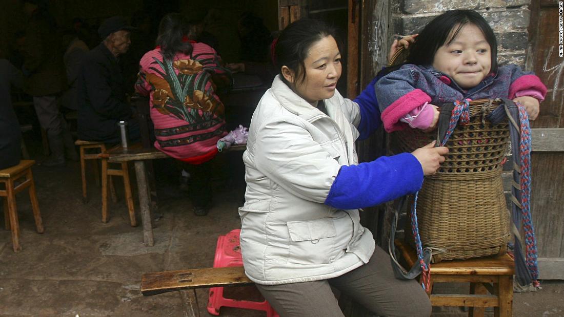 This 19-year-old girl in Neijiang, China, is being carried in a basket because she has rickets. Rickets is caused by a lack of vitamin D, which we get from sunlight. Experts believe rickets is making a comeback in developed countries because of the use of sunscreen and less time spent outdoors.  