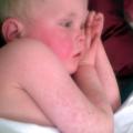 small child sick with scarlet fever