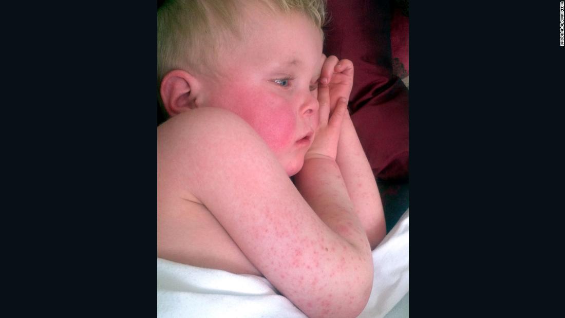 In the 19th century, scarlet fever was a common killer in Europe. In 2016, nearly 20,000 cases were reported in the United Kingdom -- the biggest increase in 50 years.&lt;br /&gt;&lt;br /&gt;Scarlet fever is just one disease that many have forgotten but that is by no means gone, despite our best efforts to eliminate it. 