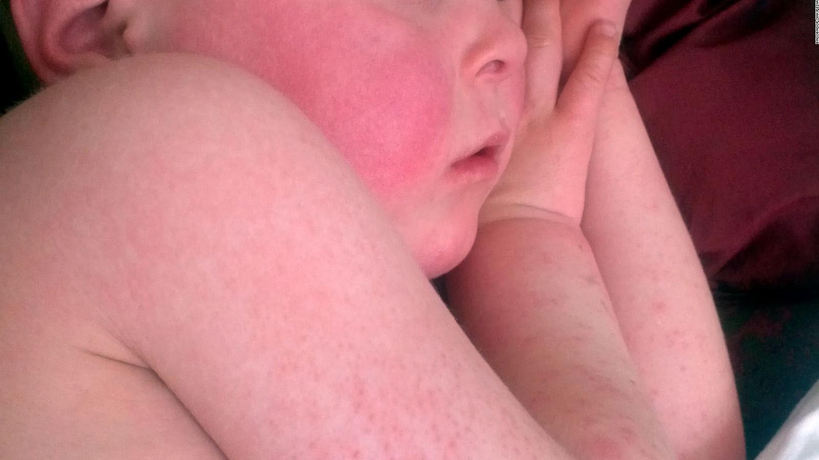 Can Scarlet Fever Flare Up