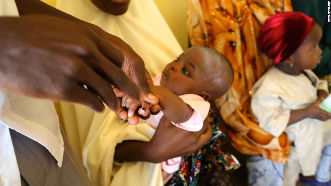 A mark on the finger after a dose of the oral vaccine means another child is covered in Nigeria&#39;s fight to eradicate polio. Only one disease has ever been eradicated -- smallpox in 1980. 