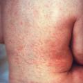 Rubella rash back