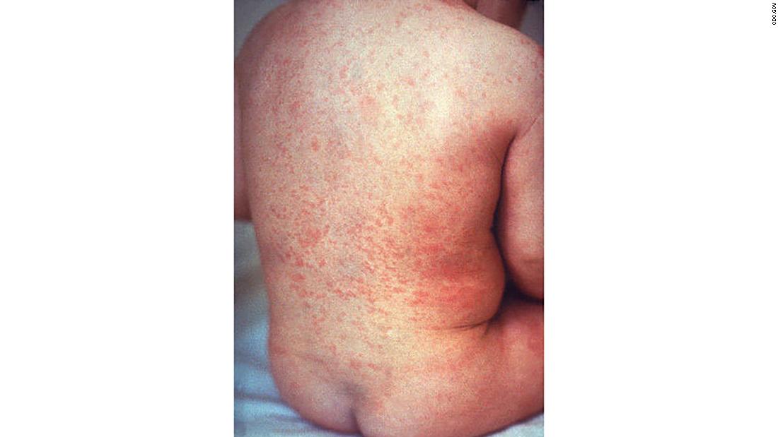 In April 2015, the Americas became the first region to eliminate rubella; the &lt;a href=&quot;https://www.cdc.gov/rubella/about/in-the-us.html&quot; target=&quot;_blank&quot;&gt;Centers for Disease Control and Prevention says&lt;/a&gt; there are fewer than 10 cases each year.&lt;strong&gt; &lt;/strong&gt;But globally, about &lt;a href=&quot;https://measlesrubellainitiative.org/resources/advocacy-tools/2017-fact-sheet/&quot; target=&quot;_blank&quot;&gt;110,000 babies&lt;/a&gt; are born with &lt;a href=&quot;http://www.cnn.com/2016/09/08/health/rubella-house-zika-babies-future/index.html&quot;&gt;congenital rubella syndrome&lt;/a&gt; every year. 