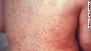 Scarlet fever cases rise, leaving researchers baffled