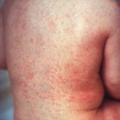 Rubella rash back