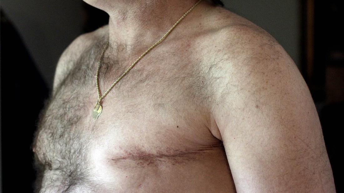 Double Mastectomies For Men With Breast Cancer On Rise Cnn 