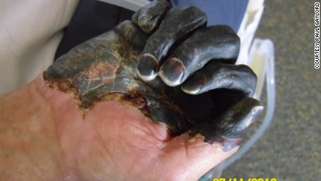 Paul Gaylord&#39;s hand as it developed gangrene. 