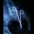 15 xray tool left 25 medical mistakes 