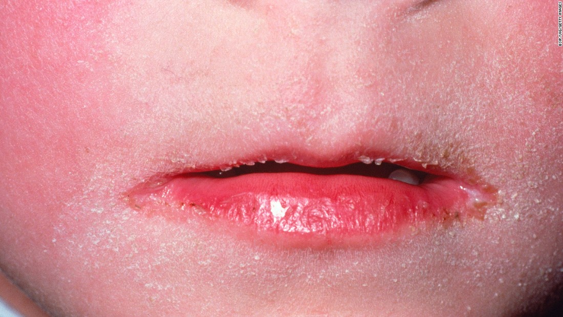 how treat scarlet rash fever to childhood The illnesses to (very upsides few) CNN