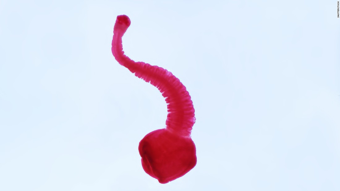 &lt;strong&gt;Tapeworm, aka Neurocysticercosis, aka T. solium:&lt;/strong&gt; This is Taenia solium, the pork tapeworm that causes one of the grossest diseases we&#39;re heard about in a while. It&#39;s responsible for the worst headache of Luis Ortiz&#39;s life. When surgeons looked in his brain, they found a &quot;wiggling&quot; tapeworm inside a cyst. That&#39;s called neurocysticercosis, and the Centers for Disease Control and Prevention says that about 1,000 people a year get them from eating something infected with &quot;microscopic eggs passed in the feces of a person who has an intestinal pork tapeworm.&quot;  