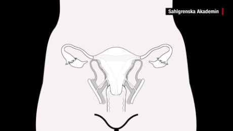 Living donor uterus transplants performed in US