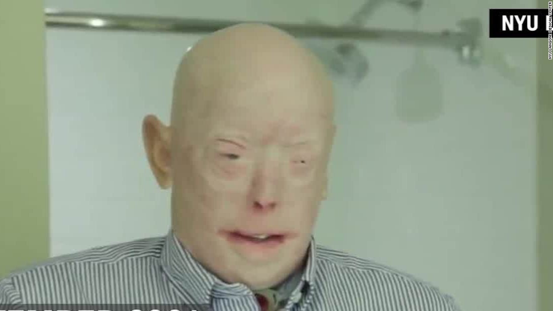 Firefighter Recovering From Historic Face Transplant Surgery Cnn Video 3903