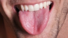 Lose fat in your tongue to improve sleep apnea, study says