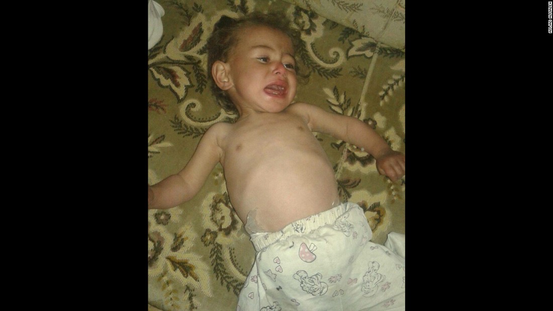 This image of a hungry child was posted on social media by an activist in the Syrian town of Madaya. CNN cannot independently verify the image.