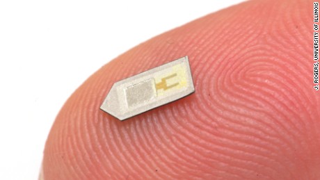 Smaller than a grain of rice, the implant wirelessly delivers critical medical data, then dissolves in body.