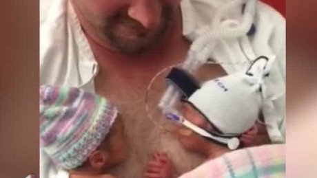 Preemie twins hold hands in viral video