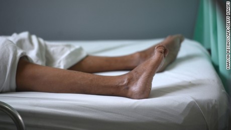 The legs of a patient suffering from Guillain-Barre syndrome recovers in the neurology ward of the Rosales National Hospital in San Salvador on January 27. Researchers are looking into a possible link between Zika and Guillan-Barre syndrome, a rare disorder that causes the body&#39;s immune system to turn on its nerves.