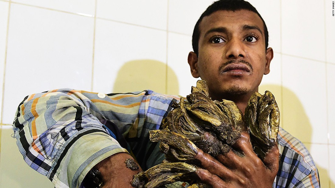 Bangladesh's 'tree man' to have surgery - CNN