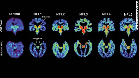 Living brain scans of five former NFL players, including Fred McNeill.