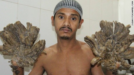 Abul Bajandra, Bangladesh&#39;s so-called &quot;Tree Man&quot; is suffering from an extremely rare genetic condition known as Epidermodysplasia Verruciformis.
