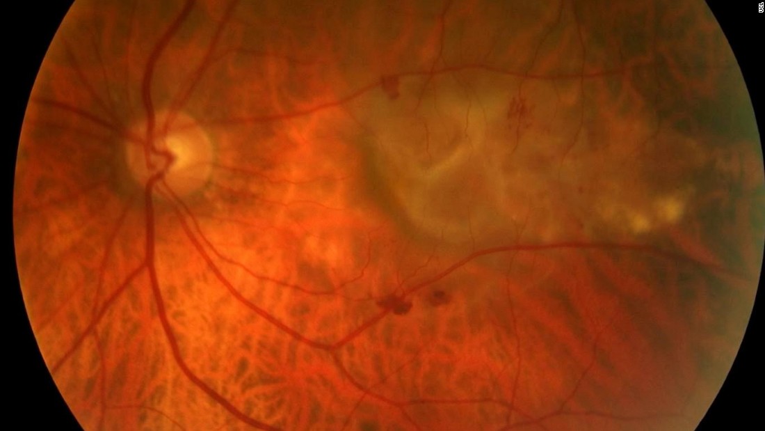 AMD affects an estimated 15 million people in North America and up to 30 million worldwide. Pictured, a severe form of Age-related Macular Degeneration (AMD) seen from the back of the eye. 