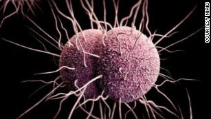 First case of super-resistant gonorrhea reported