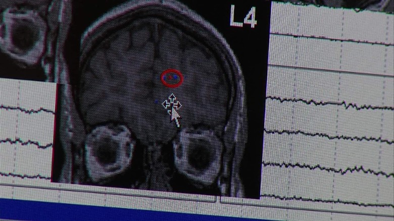 A New Method To Prevent Seizures