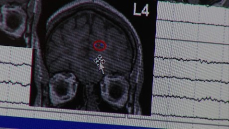 What is epilepsy? Here&#39;s what you need to know about the seizure-causing spectrum of disorders