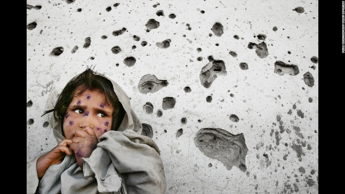 Mahbooba, 7, stands against a bullet-ridden wall waiting to be seen at a health clinic in 2002. She was suffering from a skin disease called leishmaniasis, a parasitic disease transmitted by sand fleas.
