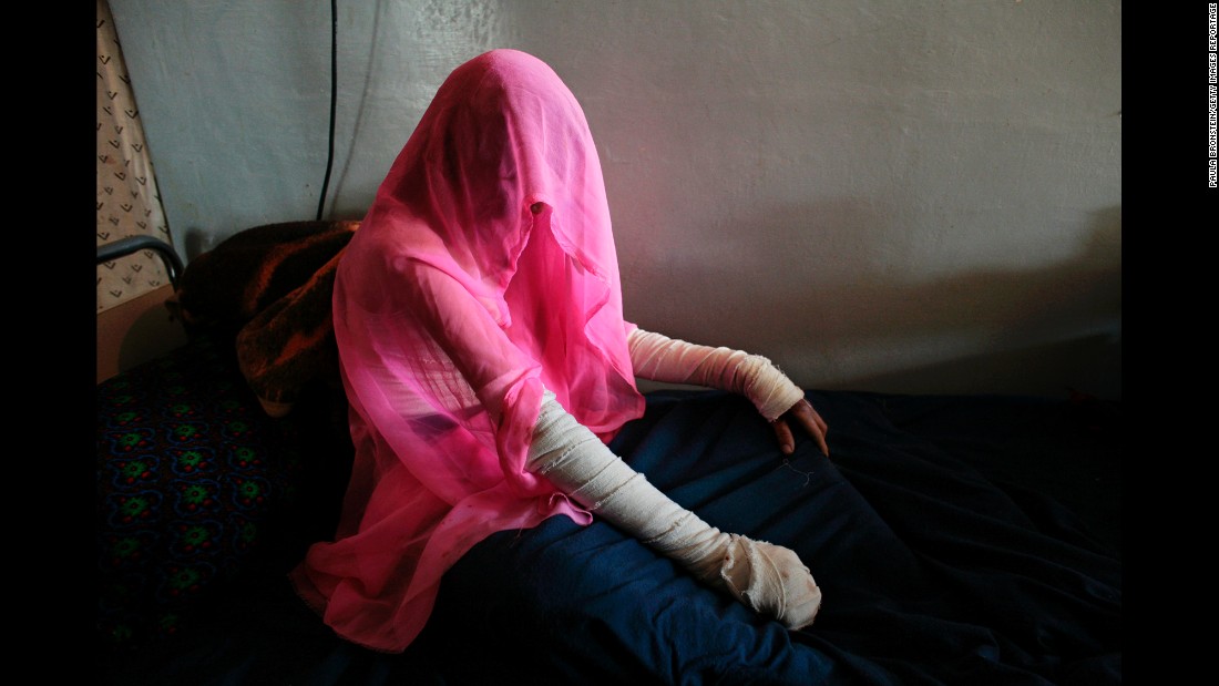Nazgul, 35, wears a headscarf at a hospital in Herat, Afghanistan, in November 2006. She tried to commit suicide by dousing herself with cooking oil.