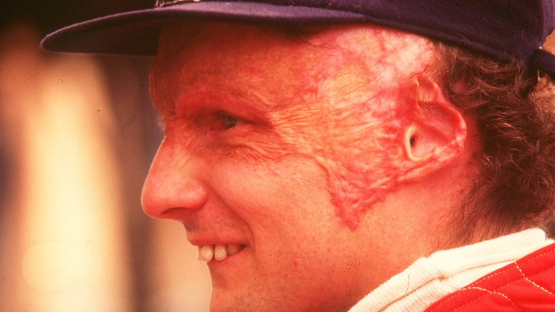 Close to death after inhaling toxic gas and suffering severe burns, Lauda returned to racing just six weeks after the accident -- though he was left with permanent scarring.