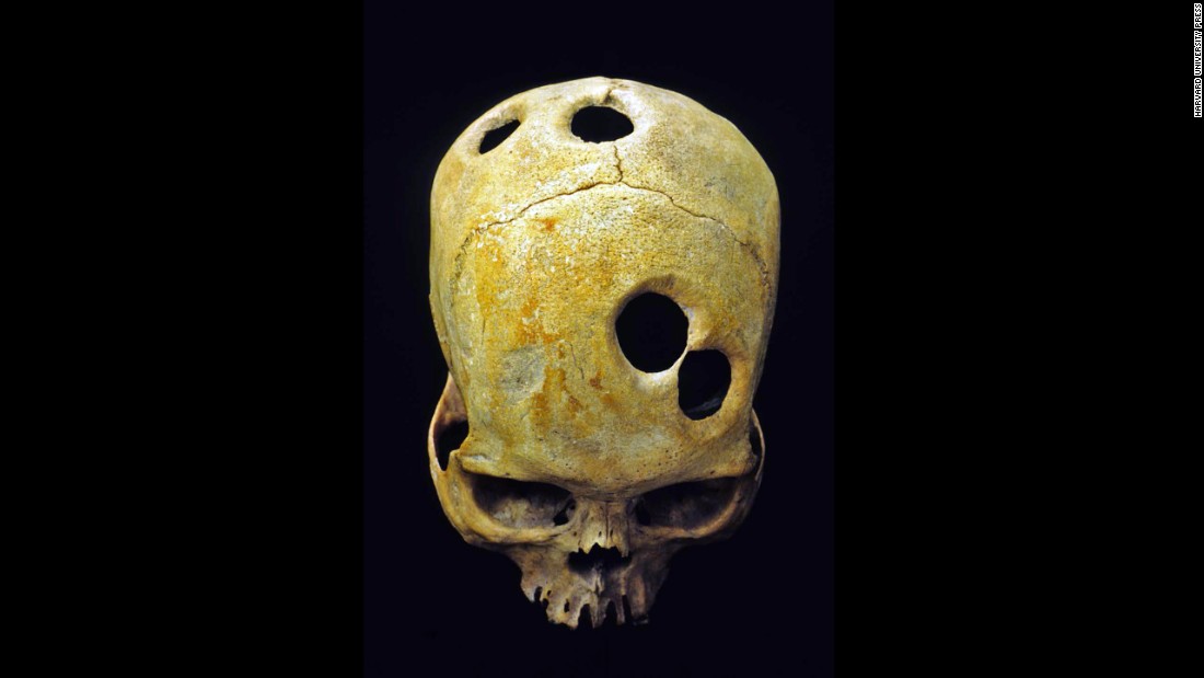 An ancient surgeon in Peru probably used a sharp tool to carefully groove the perfect circles in this Incan skull. Healed bone around the edge of the holes indicates the patient was alive during the surgery and probably survived. Scholars can&#39;t explain the purpose behind the mysterious multiple openings. 