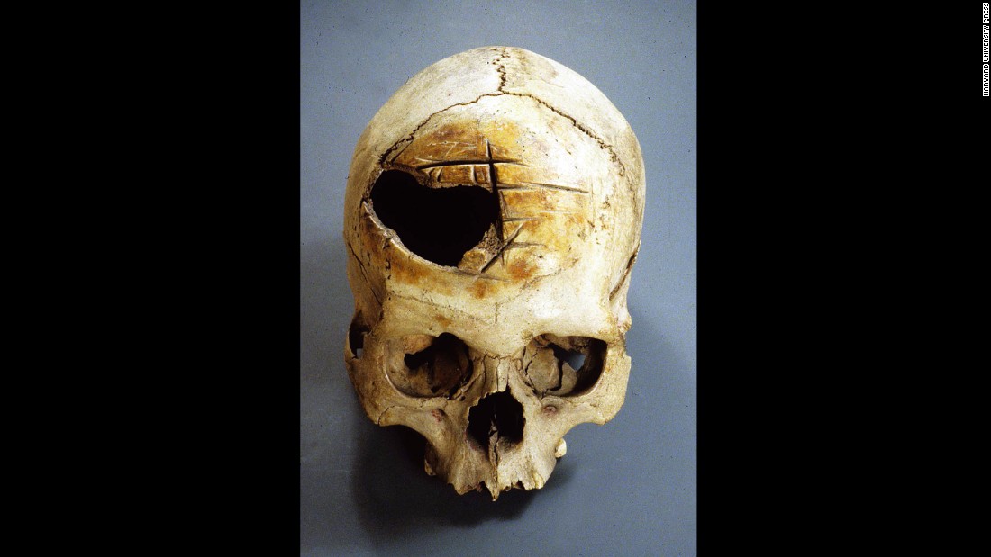 The deep, straight cuts in this Peruvian skull were made by rocking a blade back and forth. Their varying placement suggests the surgery was poorly executed and unsuccessful. 