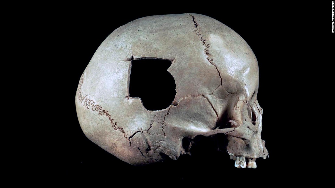 The half-circle broken out of this Peruvian skull was possibly caused by a slingshot stone. A triangular surgical hole extends from the fracture. 