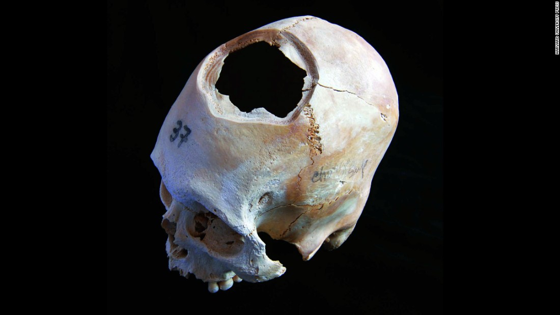 This skull is another example of early cranial surgery in Peru. Long-term survival rates were only 40%. Fewer than half the patients made it. 