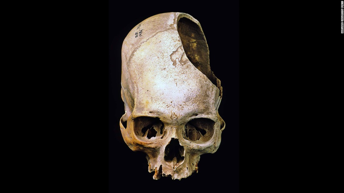 A stone blade scraped through layers and layers of bone to create the gaping hole in this skull. The operation was among the first of its kind ever performed in the Americas, about 2,400 years ago. Through the opening, a prehistoric Peruvian surgeon could clean a head would or examine the brain for bleeding. 