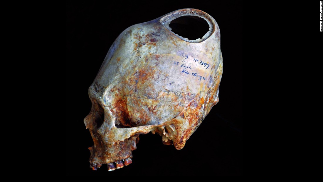 The hole in this Peruvian skull shows the different layers of bone a surgeon scraped through to create the opening: an outer layer, a spongy middle layer and a thin inner layer. Openings this large often removed all evidence of why a surgery was performed. 