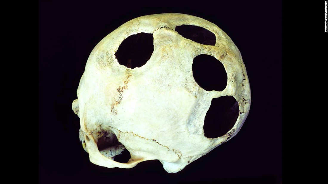 It&#39;s unlikely this Incan patient had four head injuries, each requiring surgery. The hole is another example of unexplained multiple openings. Survival rates for prehistoric cranial surgery in Peru greatly improved over the course of two millennia. In Incan times, 500 to 700 years ago, nearly 80% of patients survived. 