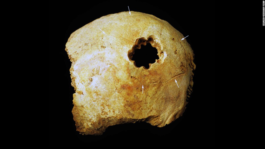 The hole in this skull was made by drilling a circle of smaller holes and then cutting away the bone between them. Of the four techniques used by Peru&#39;s ancient surgeons, it&#39;s the most similar to modern surgery. Today, to create a hole, often surgeons drill four smaller holes in a rectangle and then saw away the bone between them. 