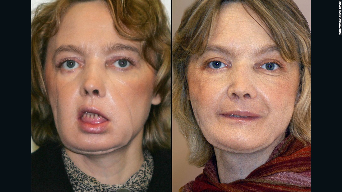 Isabelle Dinoire First Face Transplant Patient Dies At 49 CNN