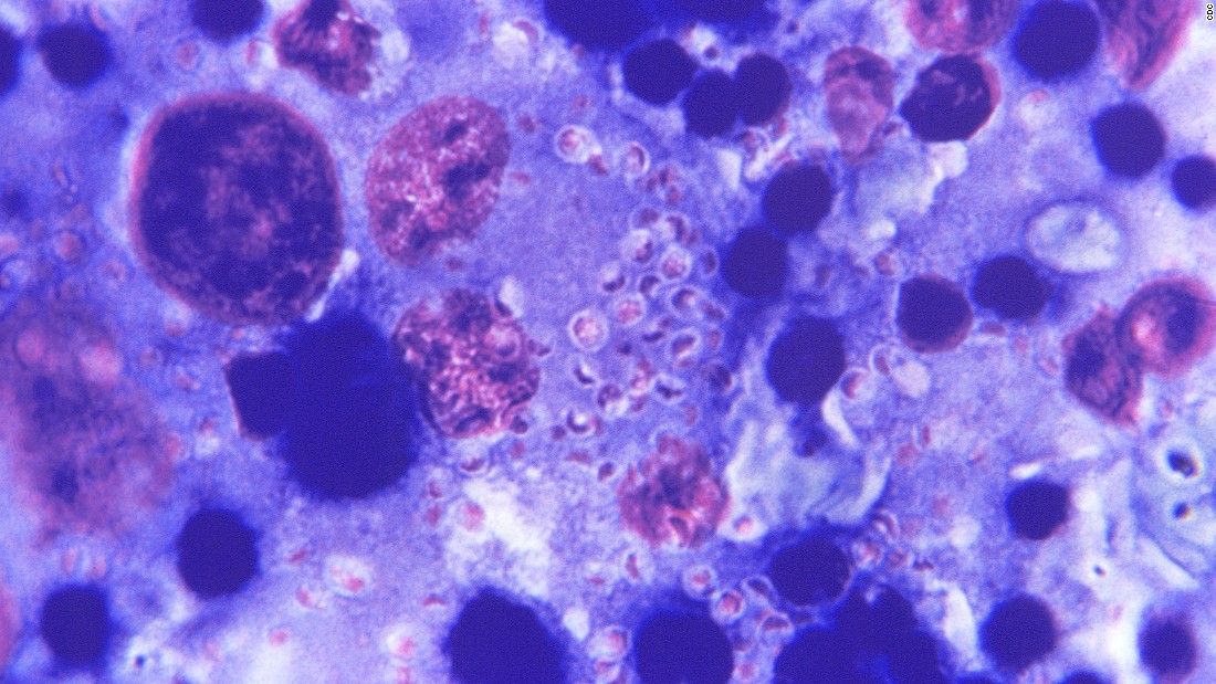 Hyperpoom Infection How fungi kill millions globally - CNN