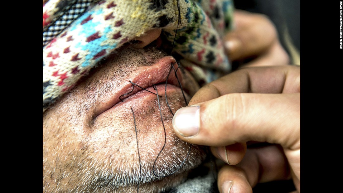 A man sews the lips of an Iranian migrant at the camp on Thursday, March 3. Journalists said at least nine Iranians stitched their mouths shut and went on a hunger strike to protest the camp&#39;s dismantling.